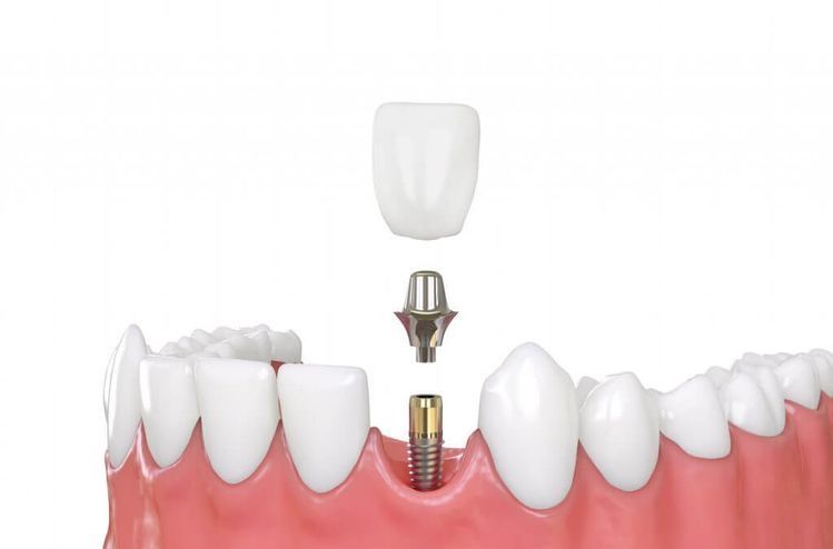 trồng răng implant yenle dental